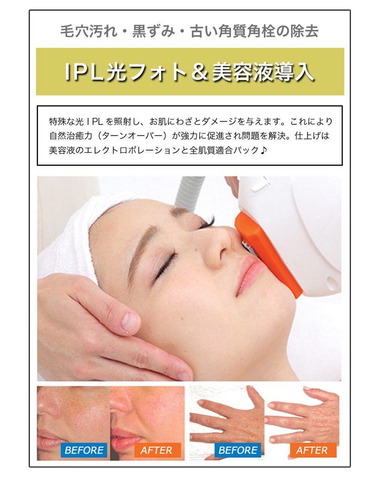 IPL光フォトフェイシャル＆美容液導入